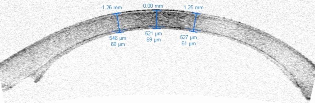 Corneal Transplant 4