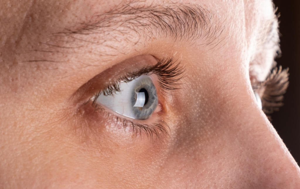 cataracts