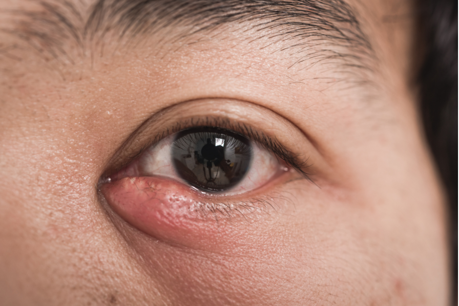 Stye causes and treatment