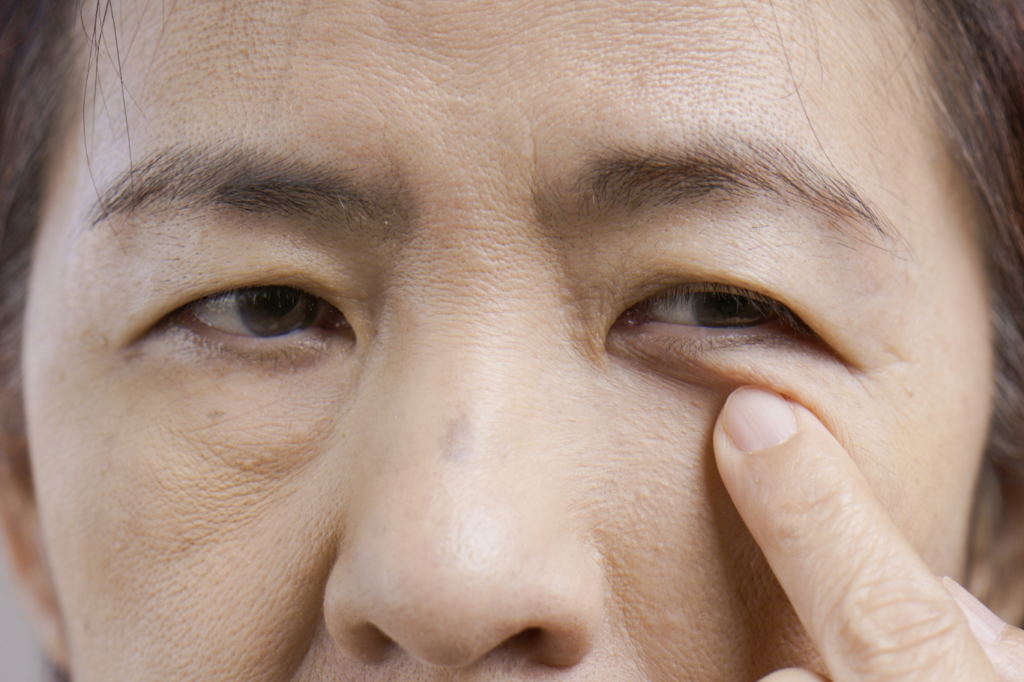 ptosis causes and treatment