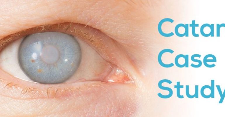 Cataract-Case-Study-Anderson-Eye-Care-1024x359