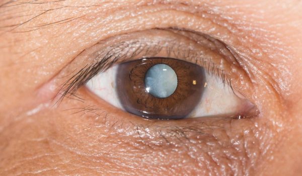 Close up of the mature cataract during eye examination.