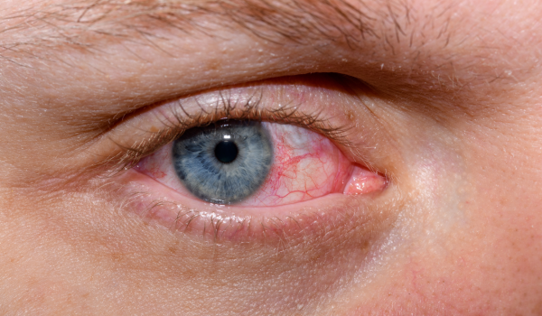 Dry Eye Disease: Causes, Symptoms, and Effective Treatments