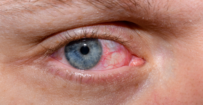 Dry Eye Disease: Causes, Symptoms, and Effective Treatments