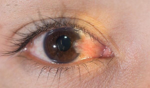 Close up of thepterygium during eye examination.