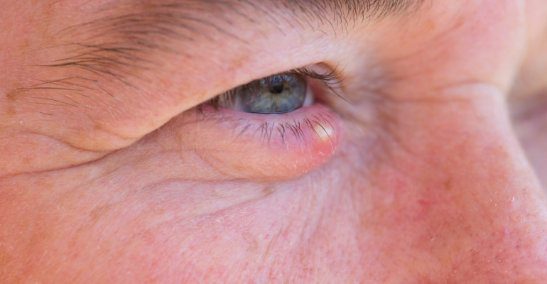 What Causes Styes & How To Treat Styes