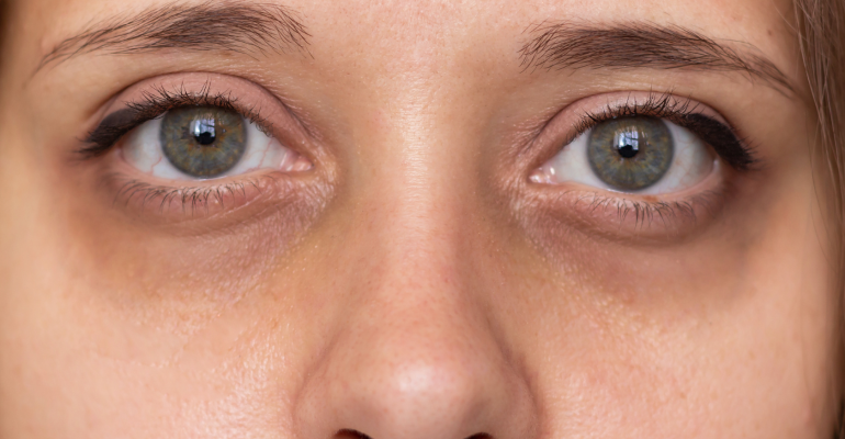 What causes dark circles around the eyes?